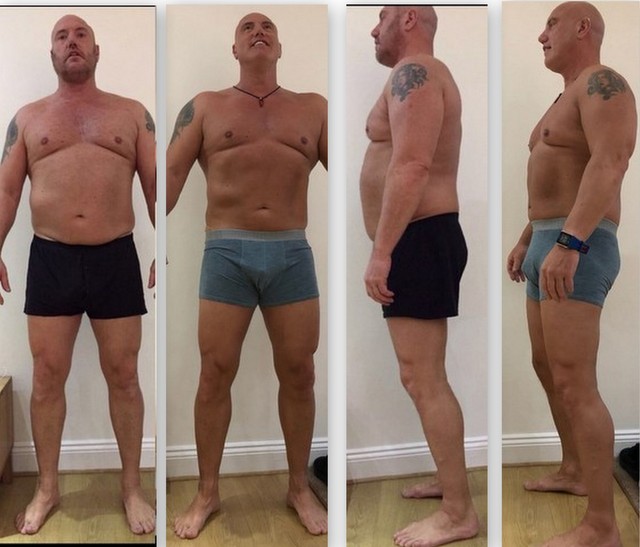 Body sculpting through Liposuction Medical Travel