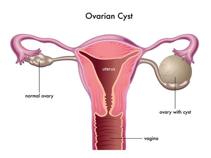 ovarian cysts