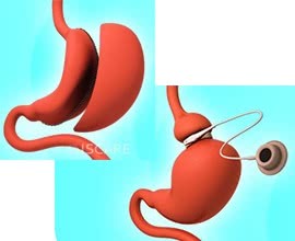 Which Bariatric Surgery Should You be Considering?