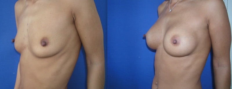 Breast augmentation 1
