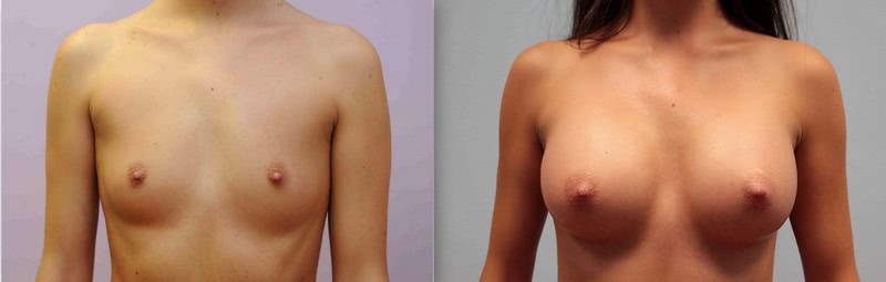 Breast augmentation 2